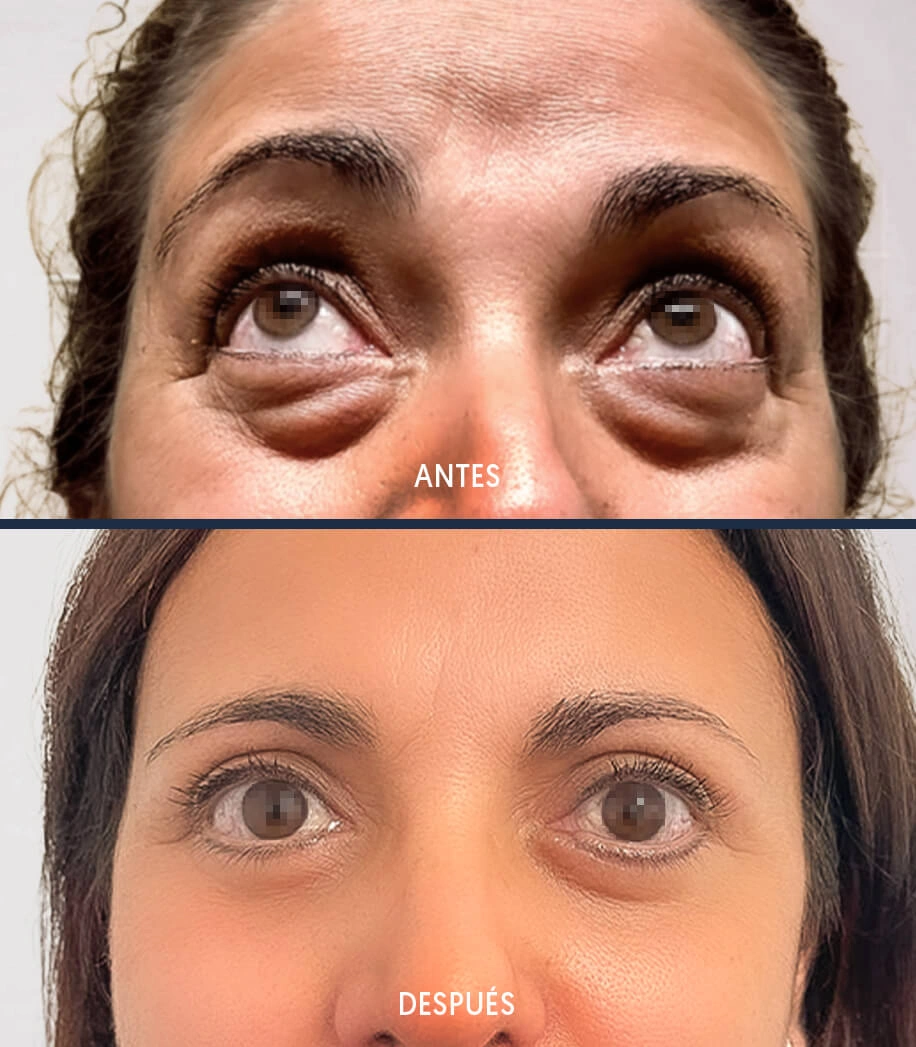 blefaroplastia