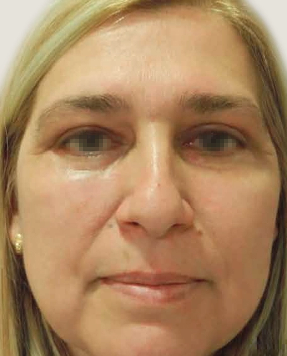 blefaroplastia