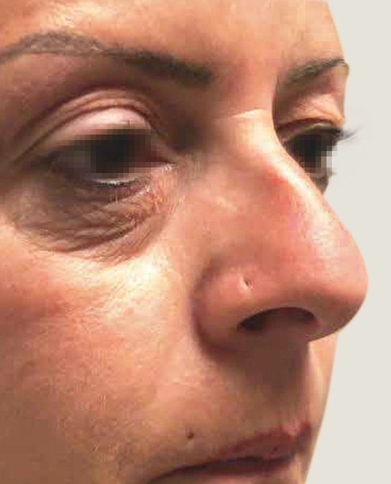 blefaroplastia