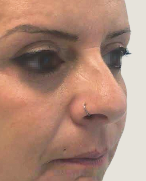 blefaroplastia