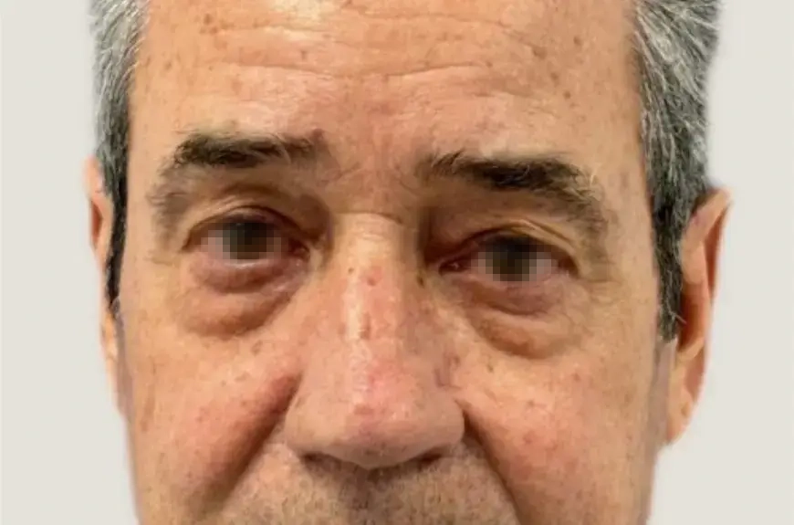 blefaroplastia