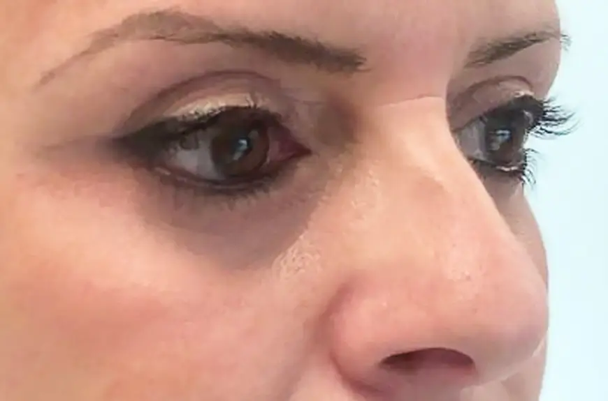 blefaroplastia