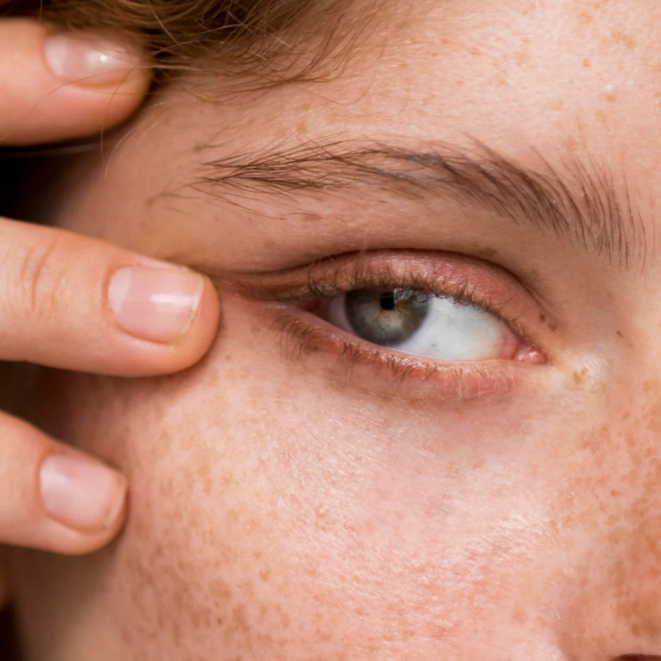 relleno de ojeras con ácido hialurónico