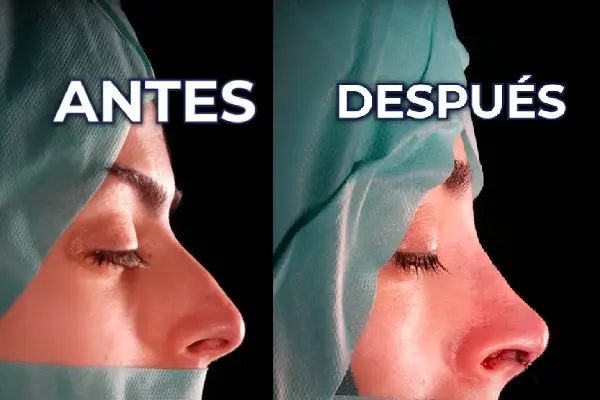 antes y despues de rinoplastia Alba